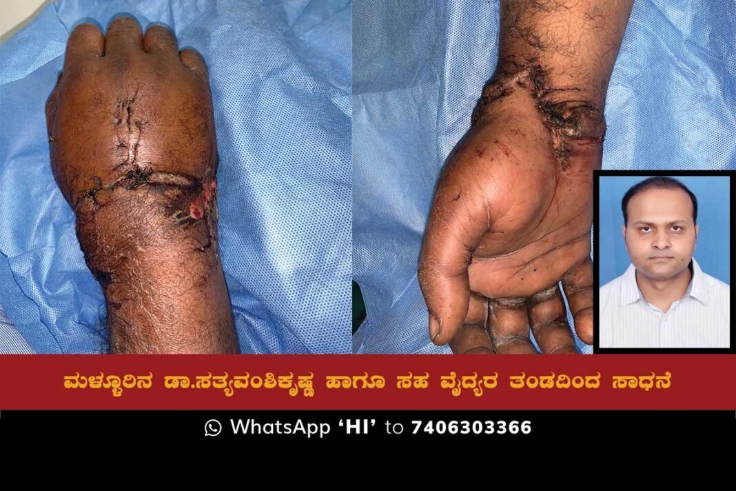 Sidlaghatta Taluk Mallur Dr. Sathyavamshikrishna Meidcal Surgery Hand Grafting success