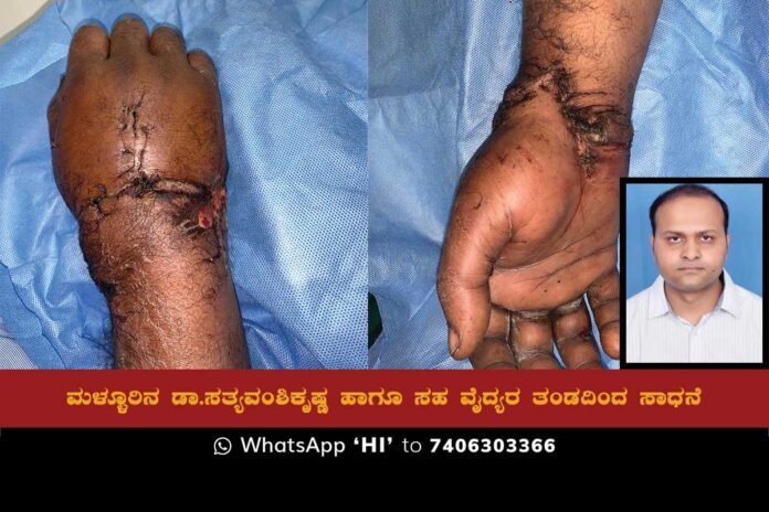 05JAN23Sd1b Sidlaghatta Taluk Mallur Dr. Sathyavamshikrishna Meidcal Surgery Hand Grafting success