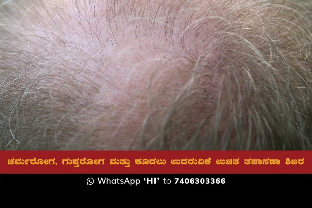A free check-up camp for dermatology, gout, and hair fall is scheduled to take place on Sunday, March 26 at the Gouramma Mallishetty Health Centre, Mallur, Sidlaghatta taluk, organized by the Puvvada Foundation.